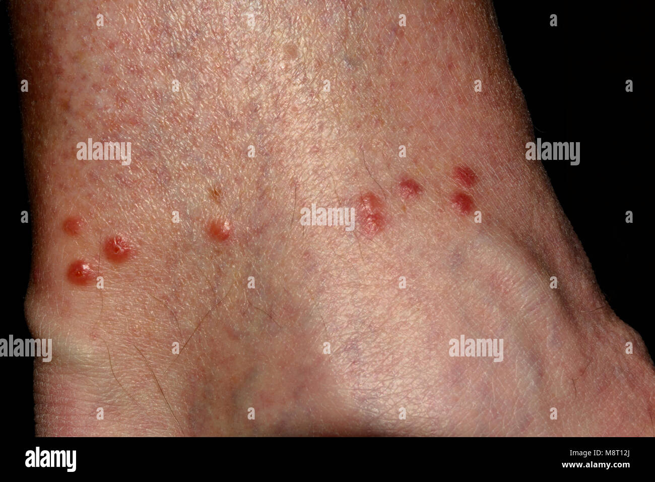 Row of Bed Bug bites to 65-year old man's ankle, Colorado US. Caused by one adult Bed Bug that has not had a blood meal in some time. Found worldwide. Stock Photo