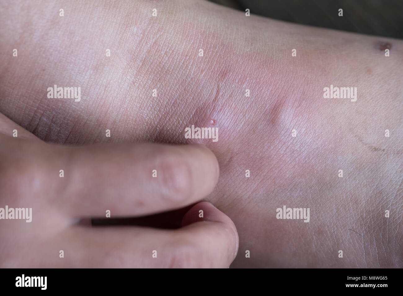 Wound leg, Diabetic foot syndrome. Gangrene of the leg. Stock Photo