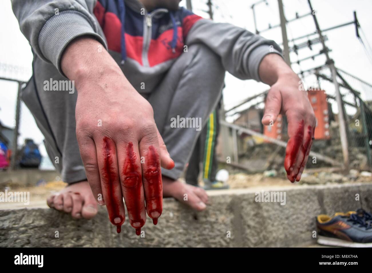 March 21, 2018 - Srinagar, J&K, India - A Kashmiri man bleeds after a traditional health worker used leeches to suck out blood as part of a treatment in Srinagar. Every year traditional health workers in Indian administered Kashmir use leeches to treat people for small, itchy, painful lumps that develop on the skin called chilblains, acquired during winter on Nowruz, which marks the first day of spring and the beginning of the year in the Persian calendar. Credit: Saqib Majeed/SOPA Images/ZUMA Wire/Alamy Live News Stock Photo