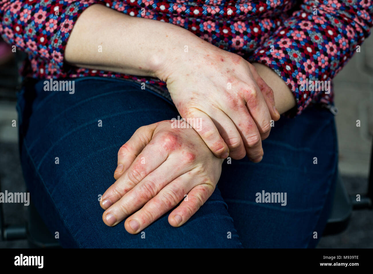 Young woman's hands with dry and stressed red dyshidrotic eczema Stock