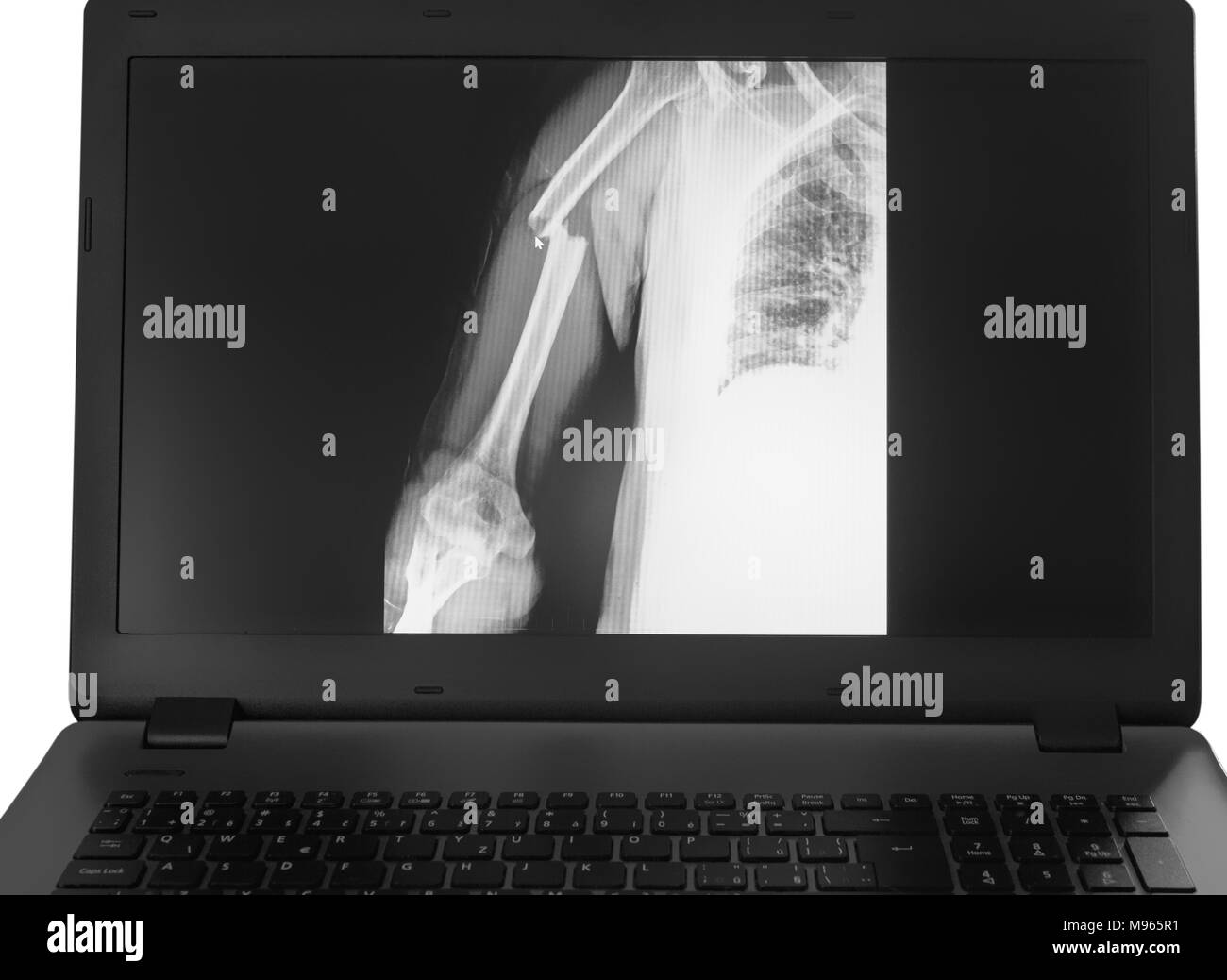 X-ray image of broken arm on monitor of pc on the white background. Stock Photo
