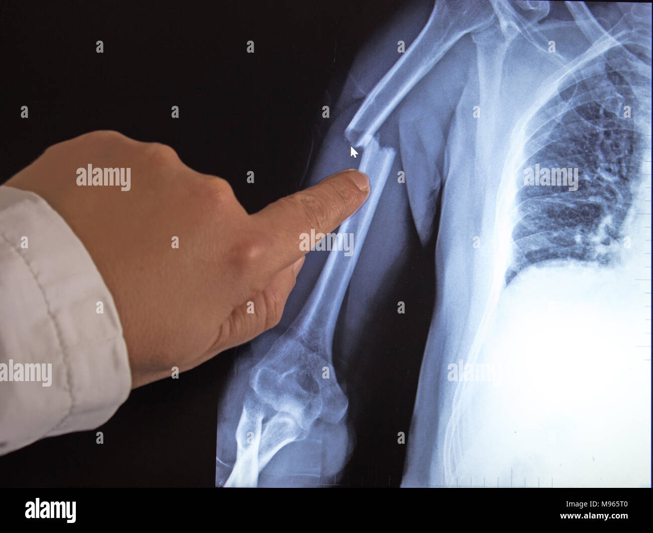 X-ray image of broken arm on monitor of pc. The doctor shows by  finger on a broken arm. Stock Photo