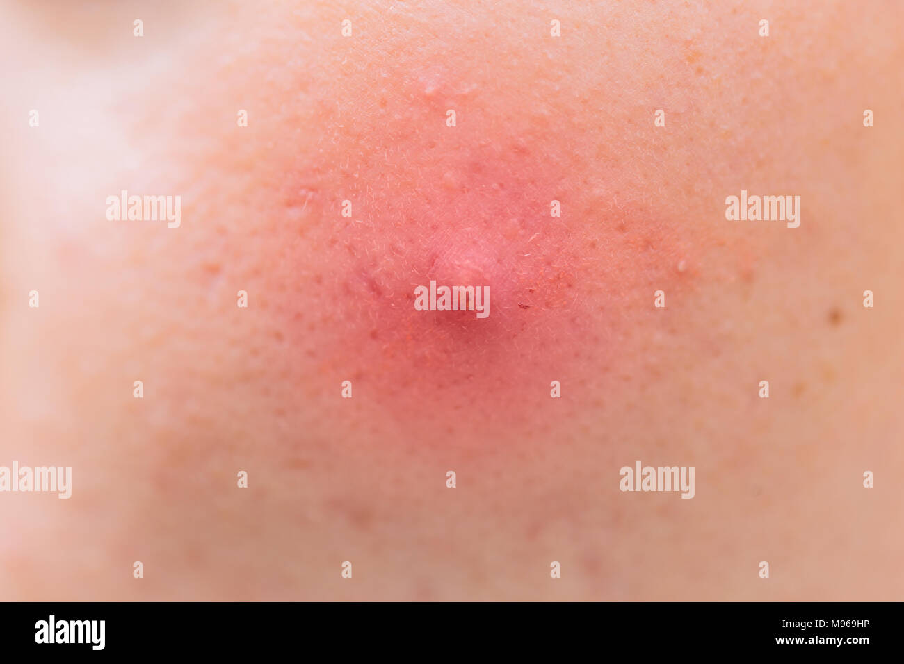 Closeup Big Acne Head skin Inflammation problem Stock Photo