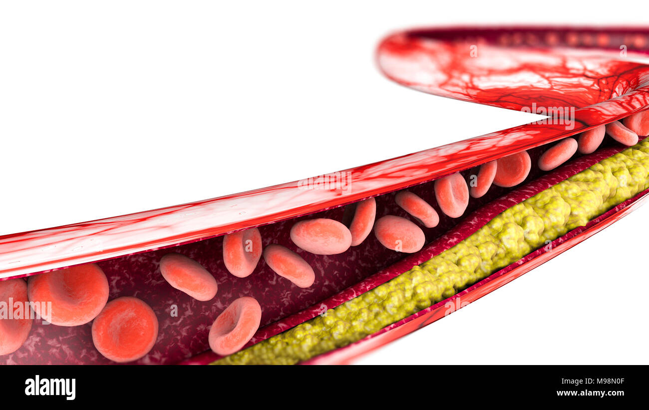 Cholesterol formation, fat, artery, vein, heart. Narrowing of a vein for fat formation Stock Photo