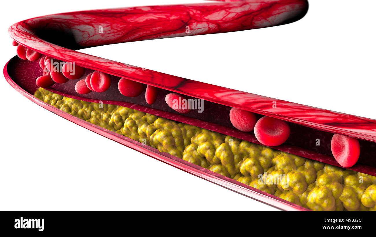 Cholesterol formation, fat, artery, vein, heart. Narrowing of a vein for fat formation Stock Photo