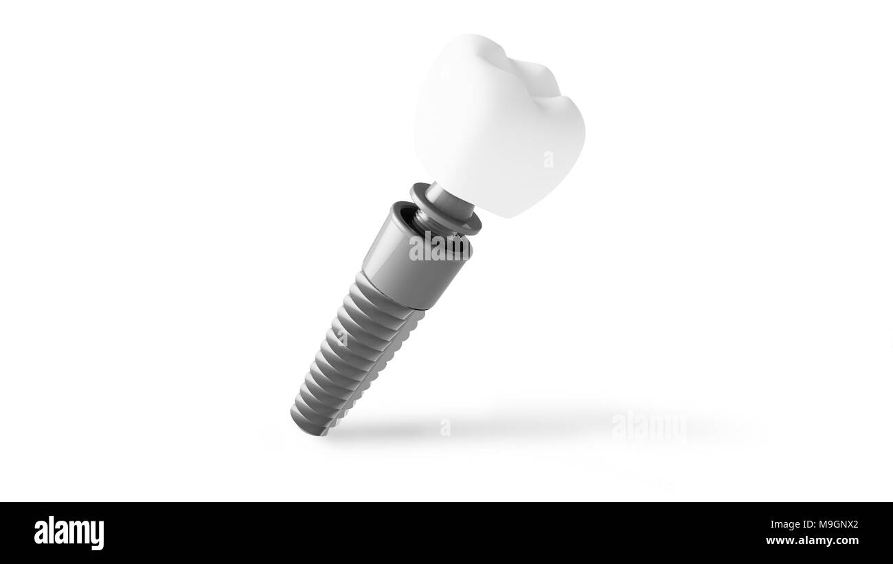 dental implant 3d rendering isolated Stock Photo Alamy