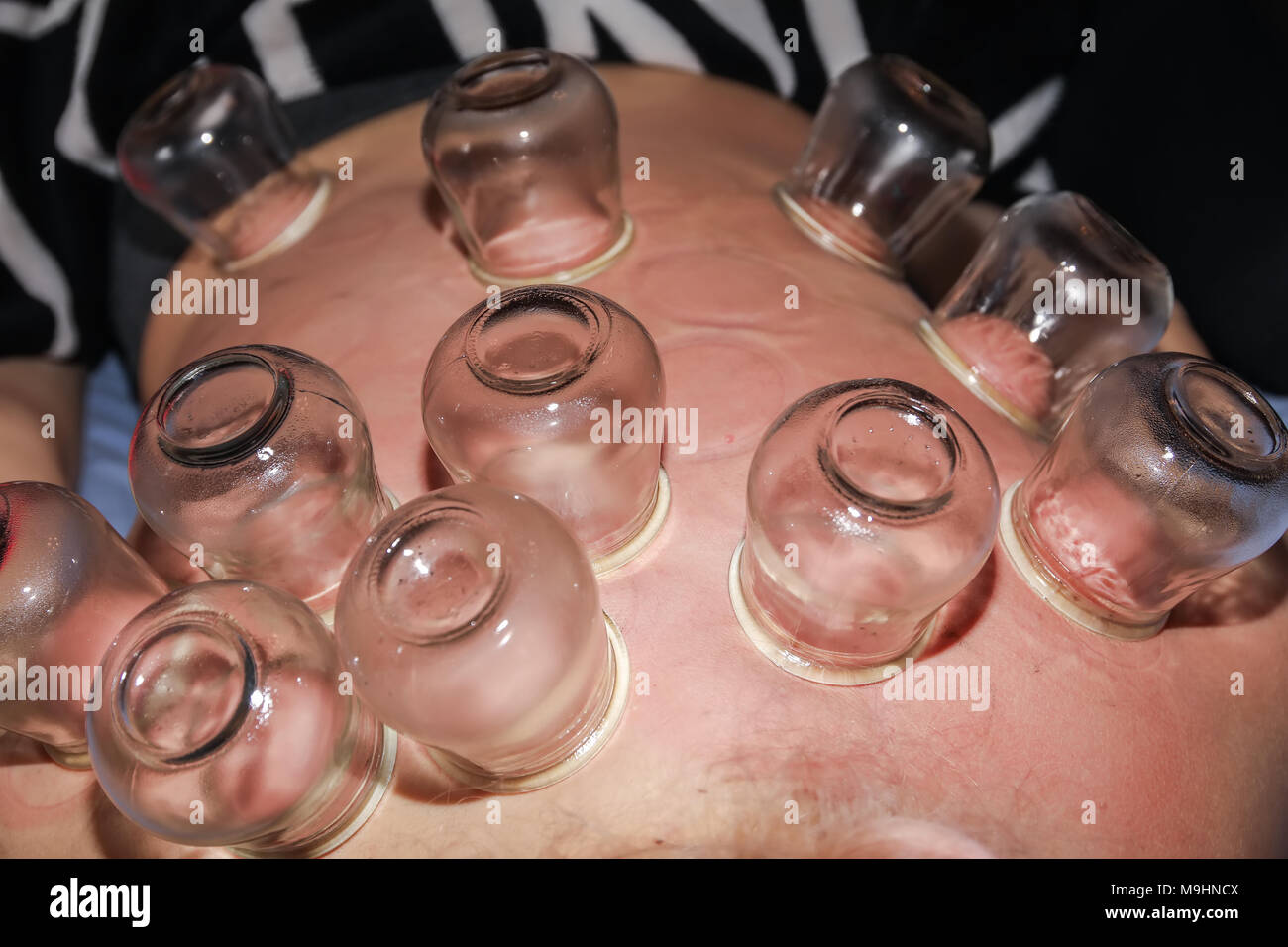 Fire cupping woman hires stock photography and images Alamy