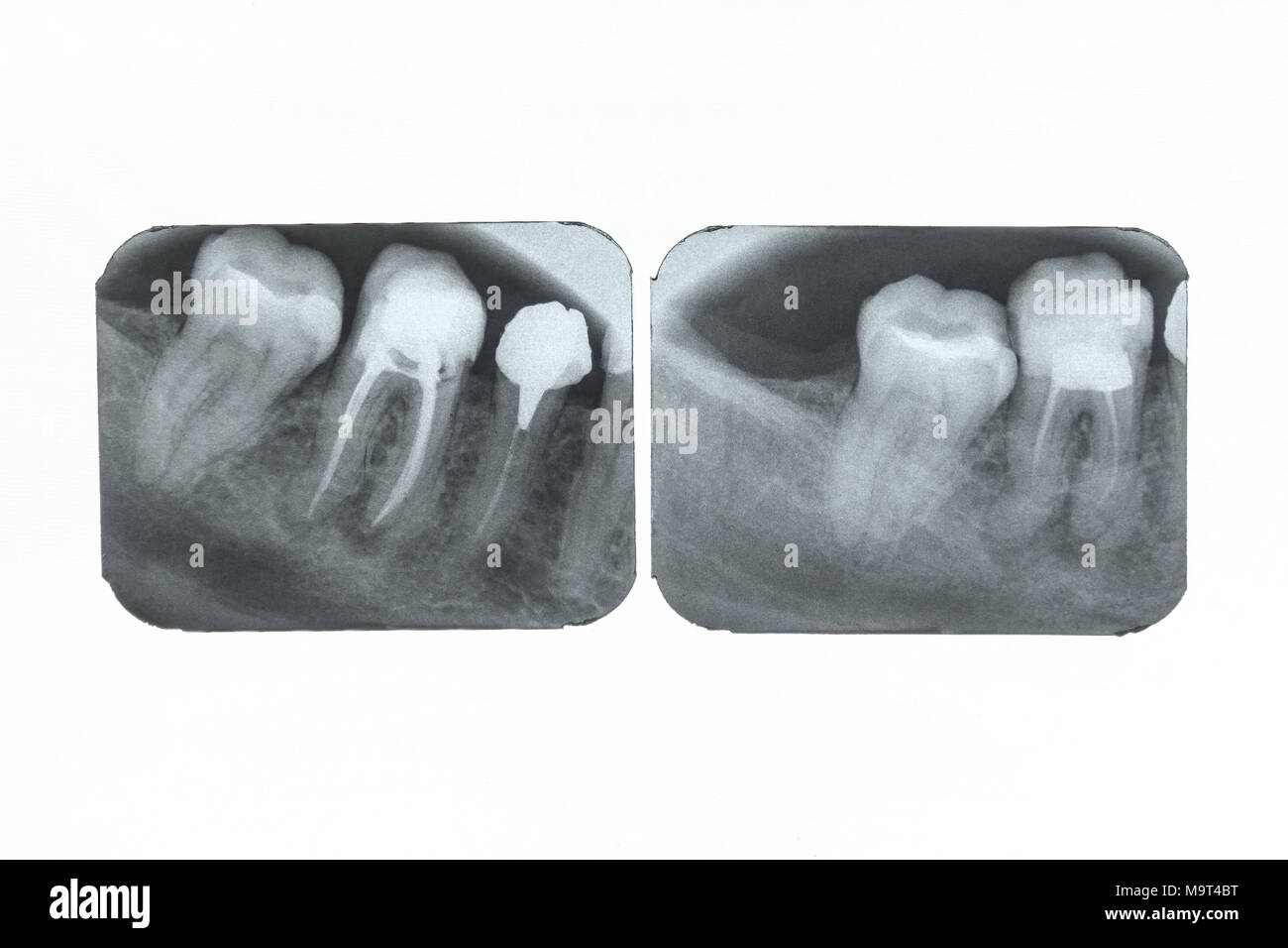 Pulpitis