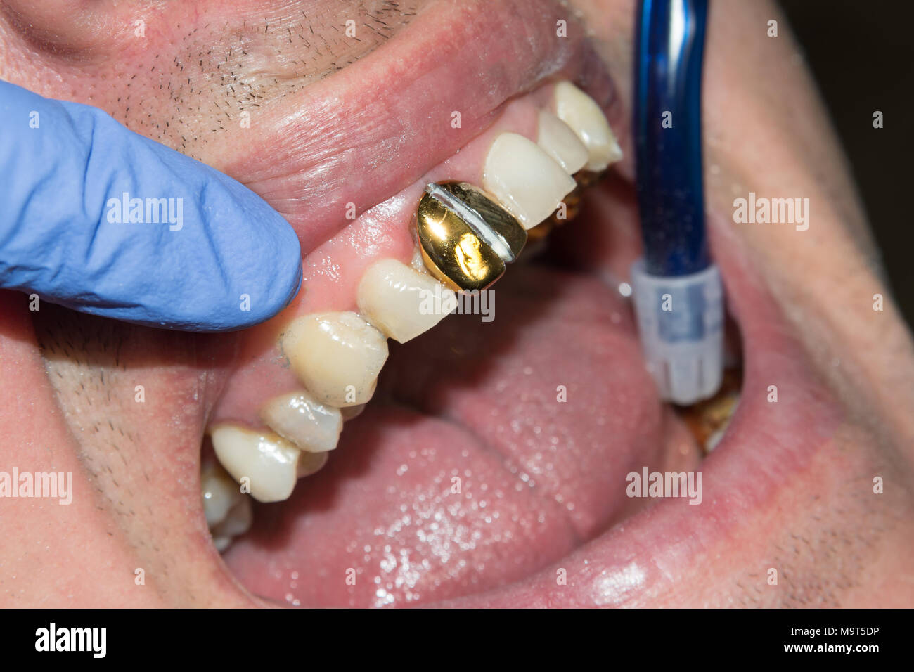photo endodontic treatment of dental canals in the lower molar permanent tooth molar with