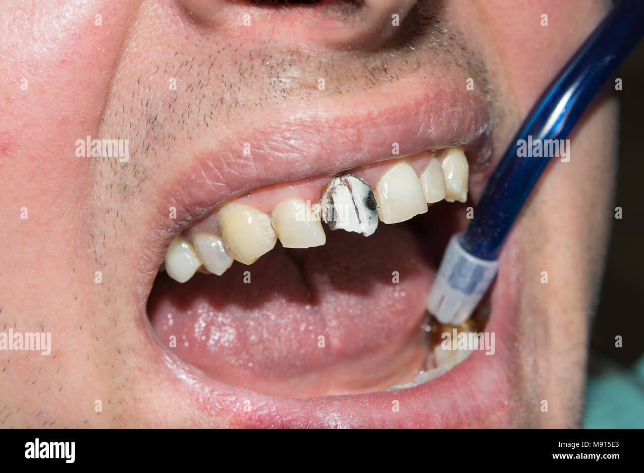 photo endodontic treatment of dental canals in the lower molar permanent tooth molar with