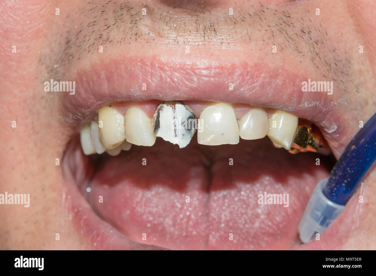 photo endodontic treatment of dental canals in the lower molar permanent tooth molar with