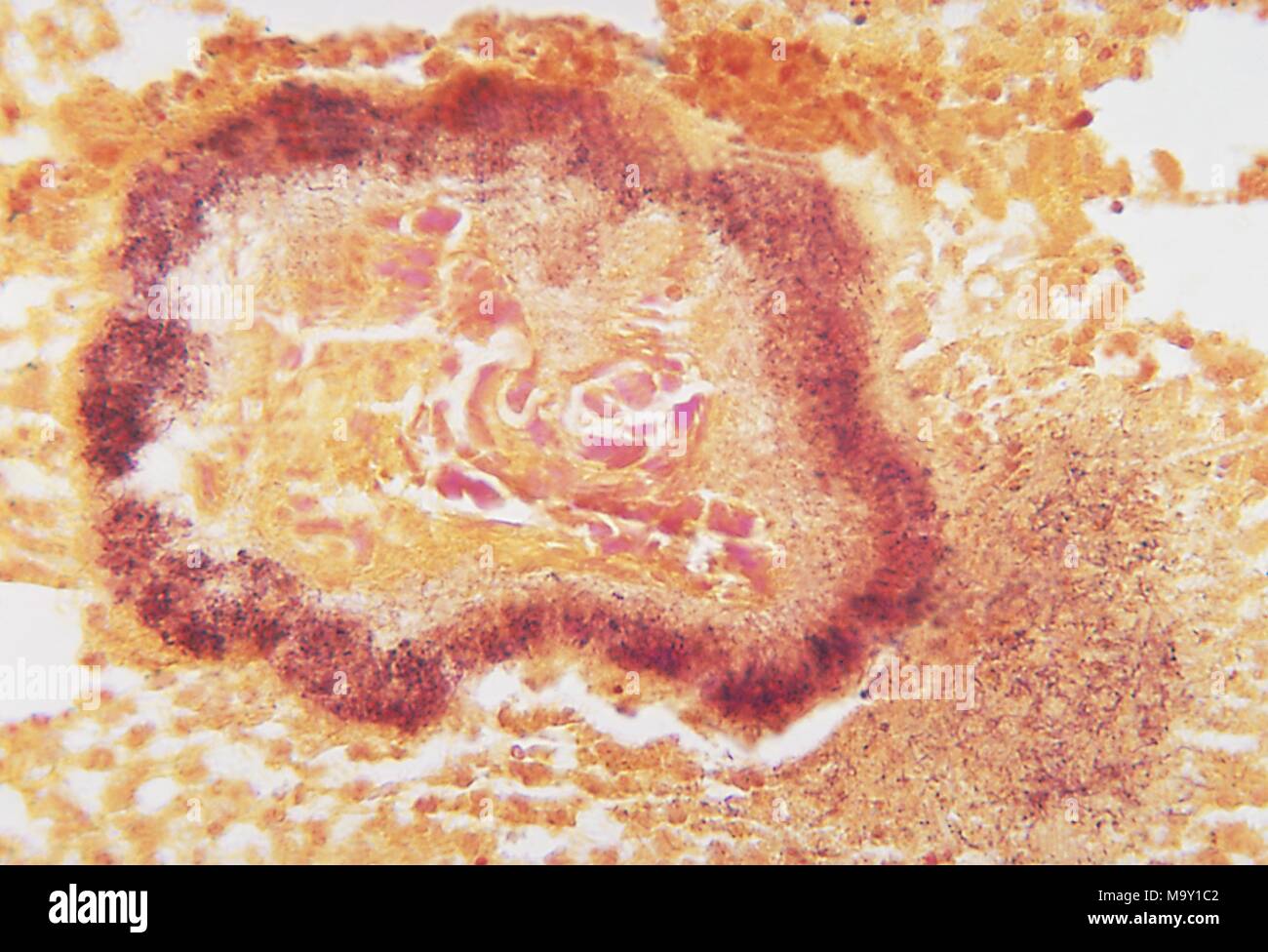 Histopathologic appearance of Black grain mycetoma, a fungal pathogen which  enters the human body through a traumatic wound, 1972. Image courtesy  CDC/Dr. Libero Ajello Stock Photo - Alamy