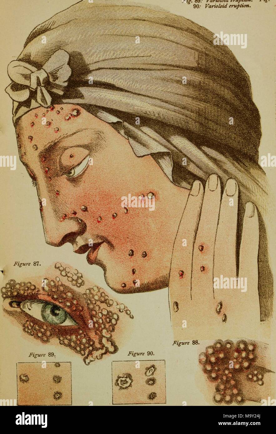 Color illustration depicting smallpox pustules, shown on the face and hand of a woman, in profile, wearing a scarf, with inset close-ups to illustrate pustule stages, and their presence on the eyelid, from the volume 'Contagious and Infectious Disease: measures for their prevention and arrest, small pox (variola), modified small pox (varioloid), chicken pox (varicella), cow pox (variole vaccinae), vaccination, spurious vaccination, ' authored by Joseph Jones, Edward Jenner, George Pearson, and William Woodville, 1884. () Stock Photo