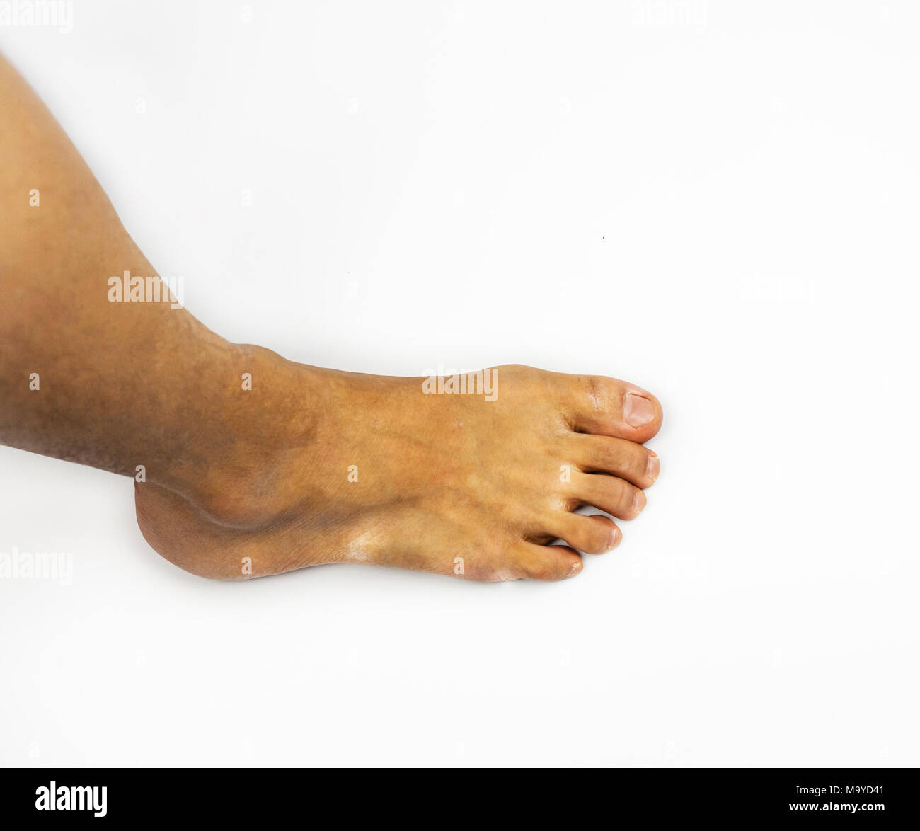Athlete's Foot Infection Stock Photos & Athlete's Foot Infection Stock Images Alamy
