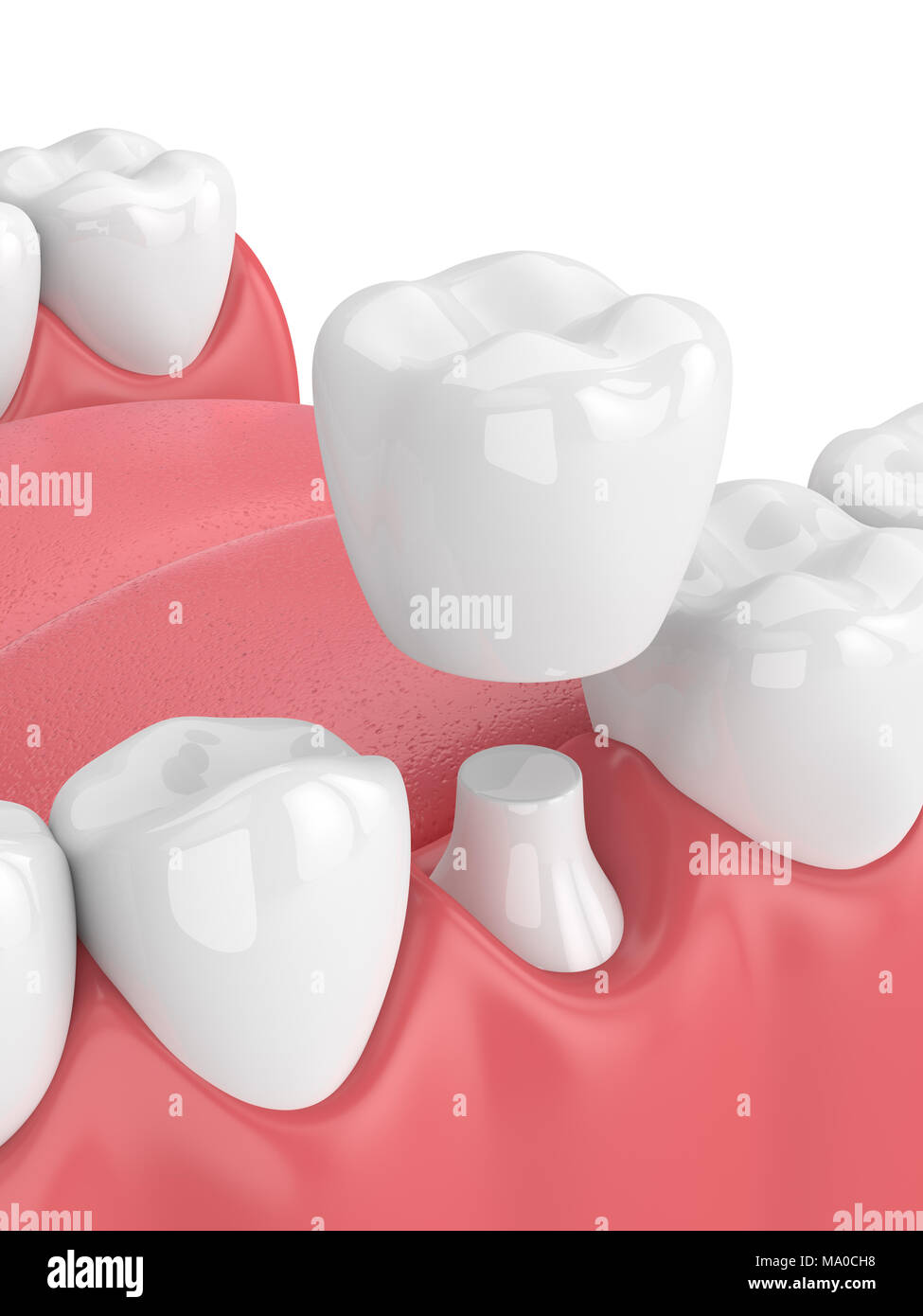 3d render of jaw with teeth and dental crown restoration over white ...