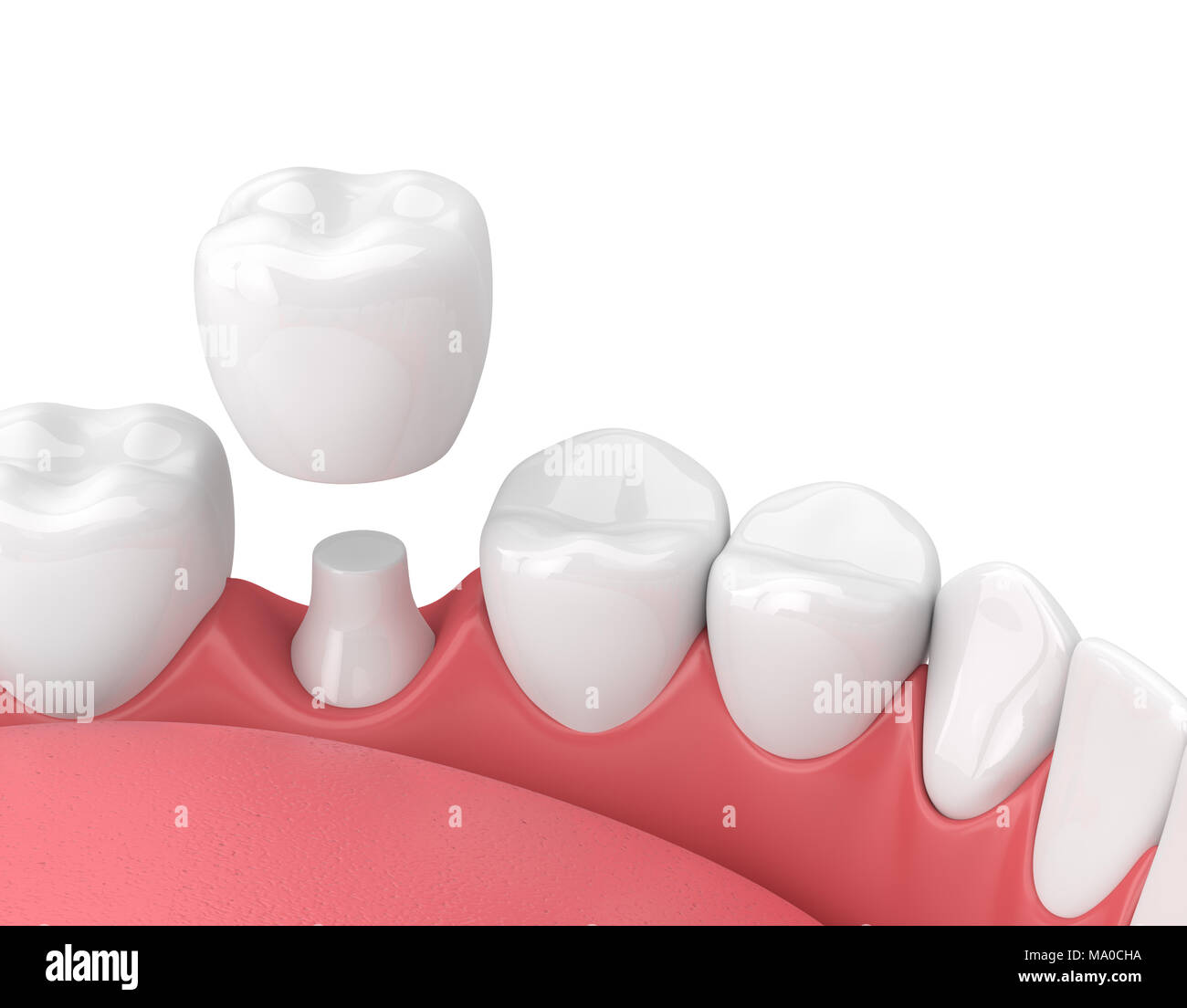 3d render of jaw with teeth and dental crown restoration over white ...