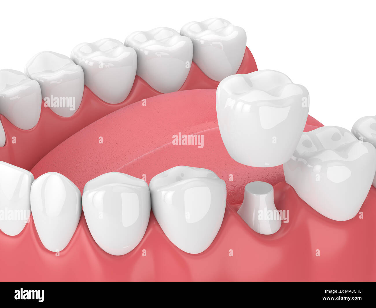 3d render of jaw with teeth and dental crown restoration over white ...