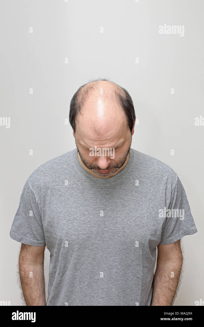 Top View of Hair Loss Problem at Middle Age Bald Man Stock Photo - Alamy
