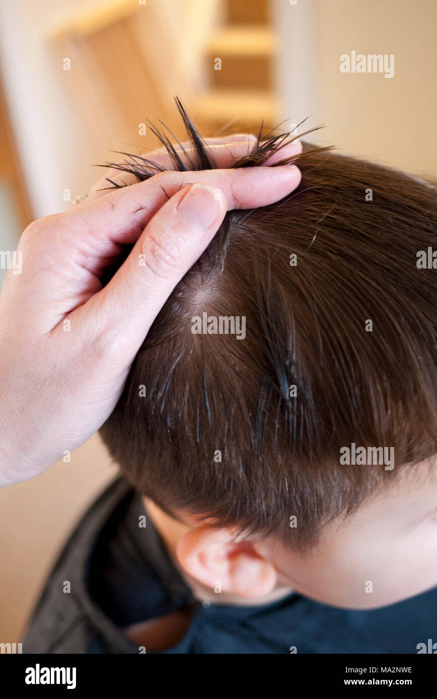 Looking For Early Signs Of Alopecia Areata On A Young Boy Stock