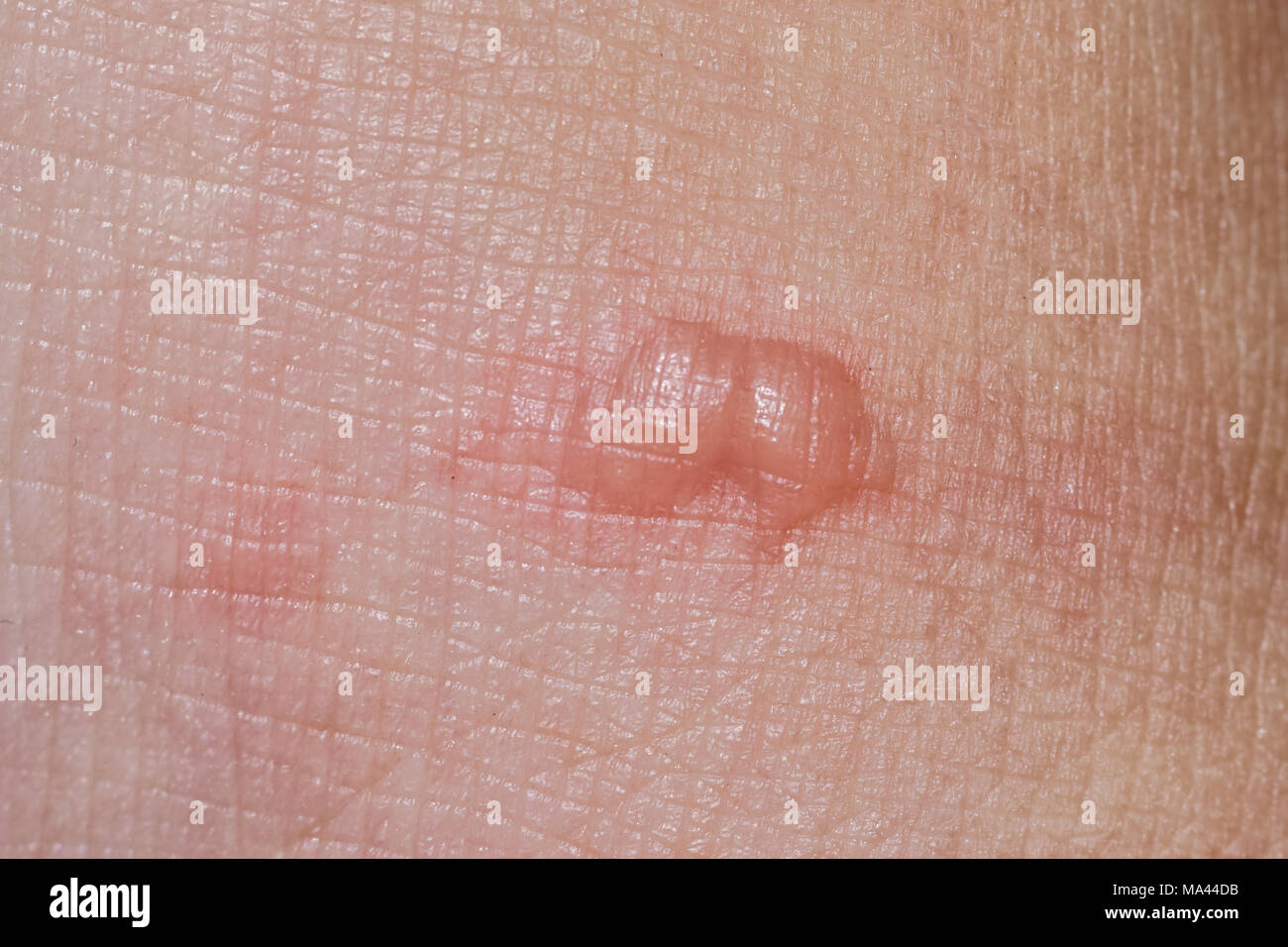 Blister Skin Stock Photos & Blister Skin Stock Images Alamy