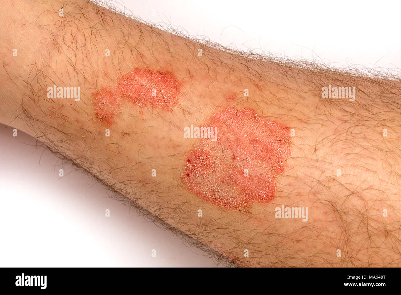 Psoriasis Skin Rash Treatment