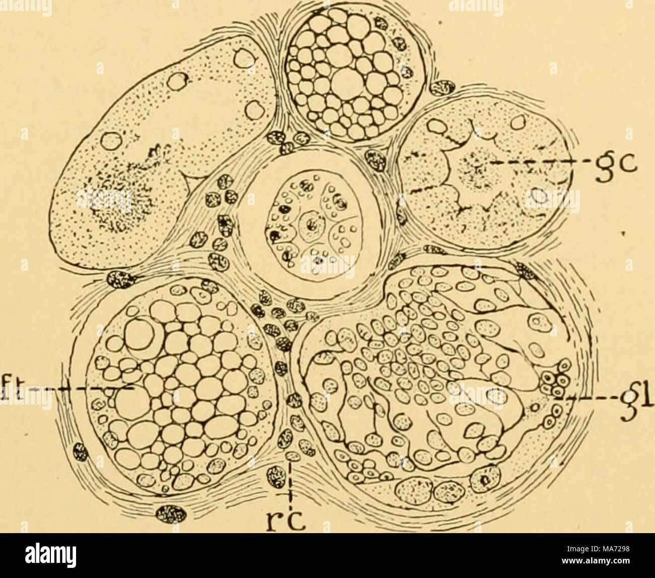 . The effects of inanition and malnutrition upon growth and structure . FlG. 99.—Portion of a section of the kidney from a young fowl on aqueous inanition (dry diet), ft, uriniferous tubules containing epithelial cells with &quot;fatty degeneration;&quot; gc, urinif- erous tubule containing a granular cylinder; gl, an abnormal renal (Malpighian) corpuscle, showing capsule and glomerulus (glomerulitis?); re, stroma, with small round cell infiltration. X400. (Pernice and Scagliosi '95a.) Many uriniferous tubules were also filled with blood, and some contained hyalin cylinders. In many glomeruli  Stock Photo