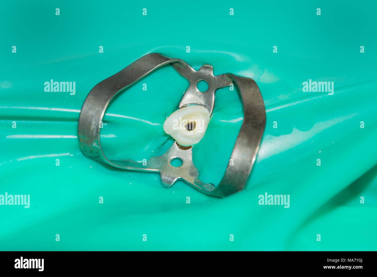 closeup treated human tooth in a dental filling rotten clinic.Cleaning