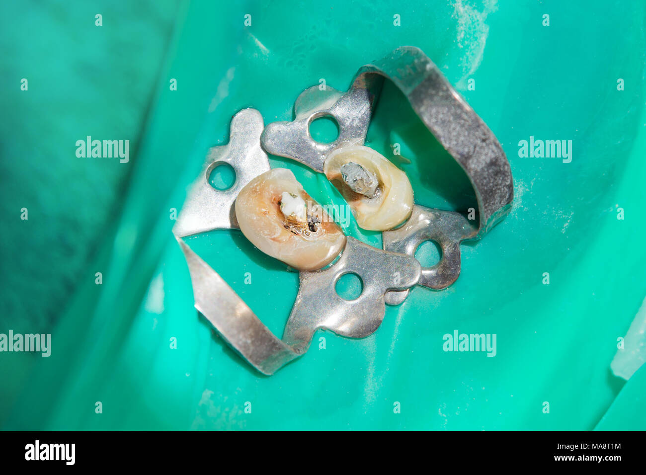 photo endodontic treatment of dental canals in the lower molar