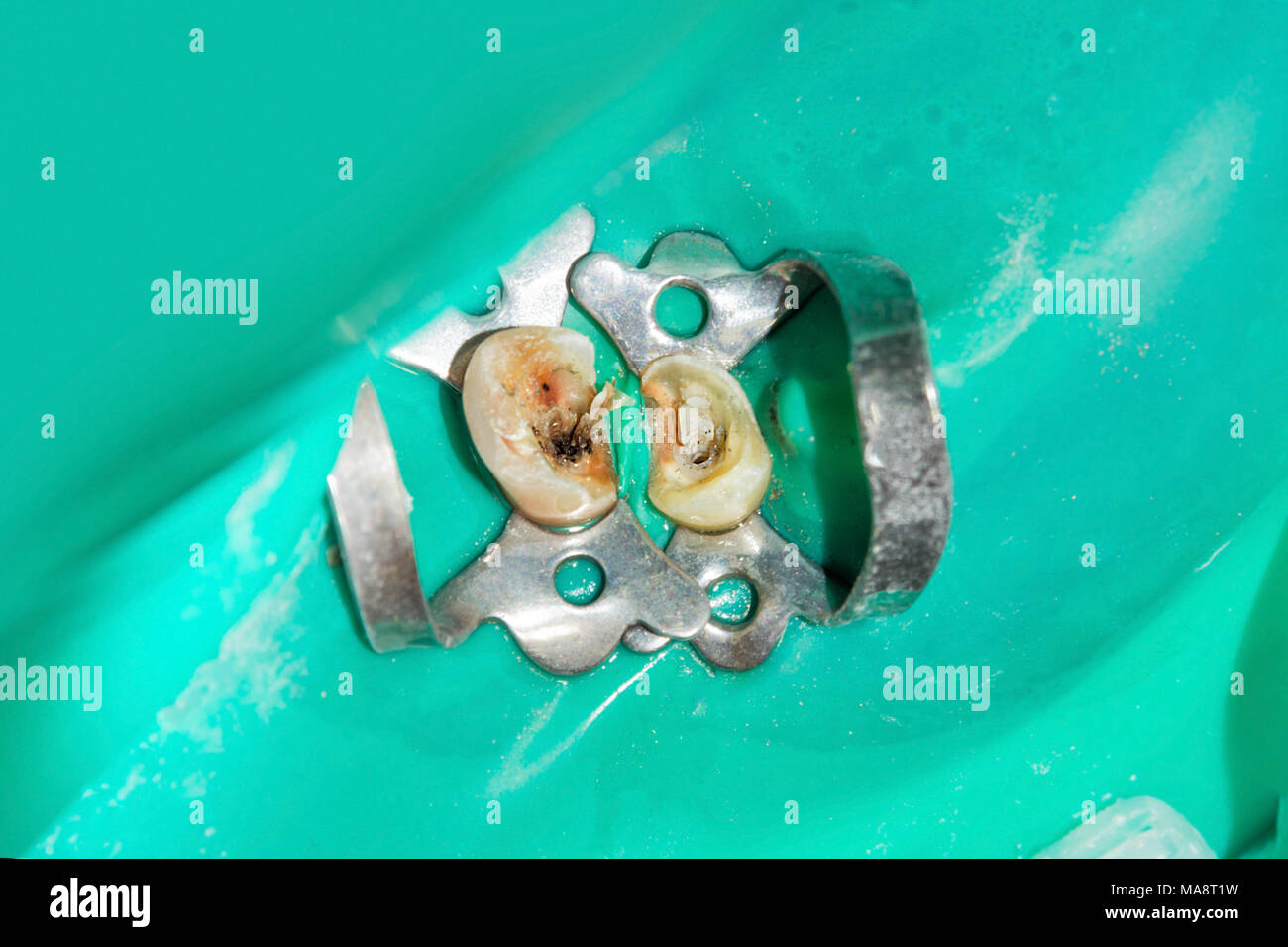 photo endodontic treatment of dental canals in the lower molar permanent tooth molar with