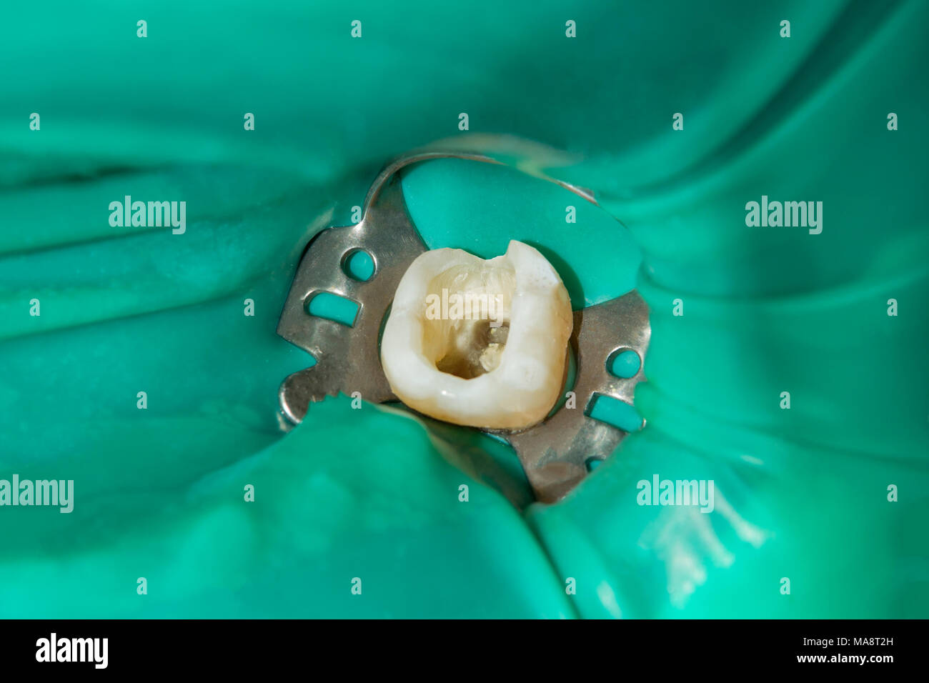 photo endodontic treatment of dental canals in the lower molar