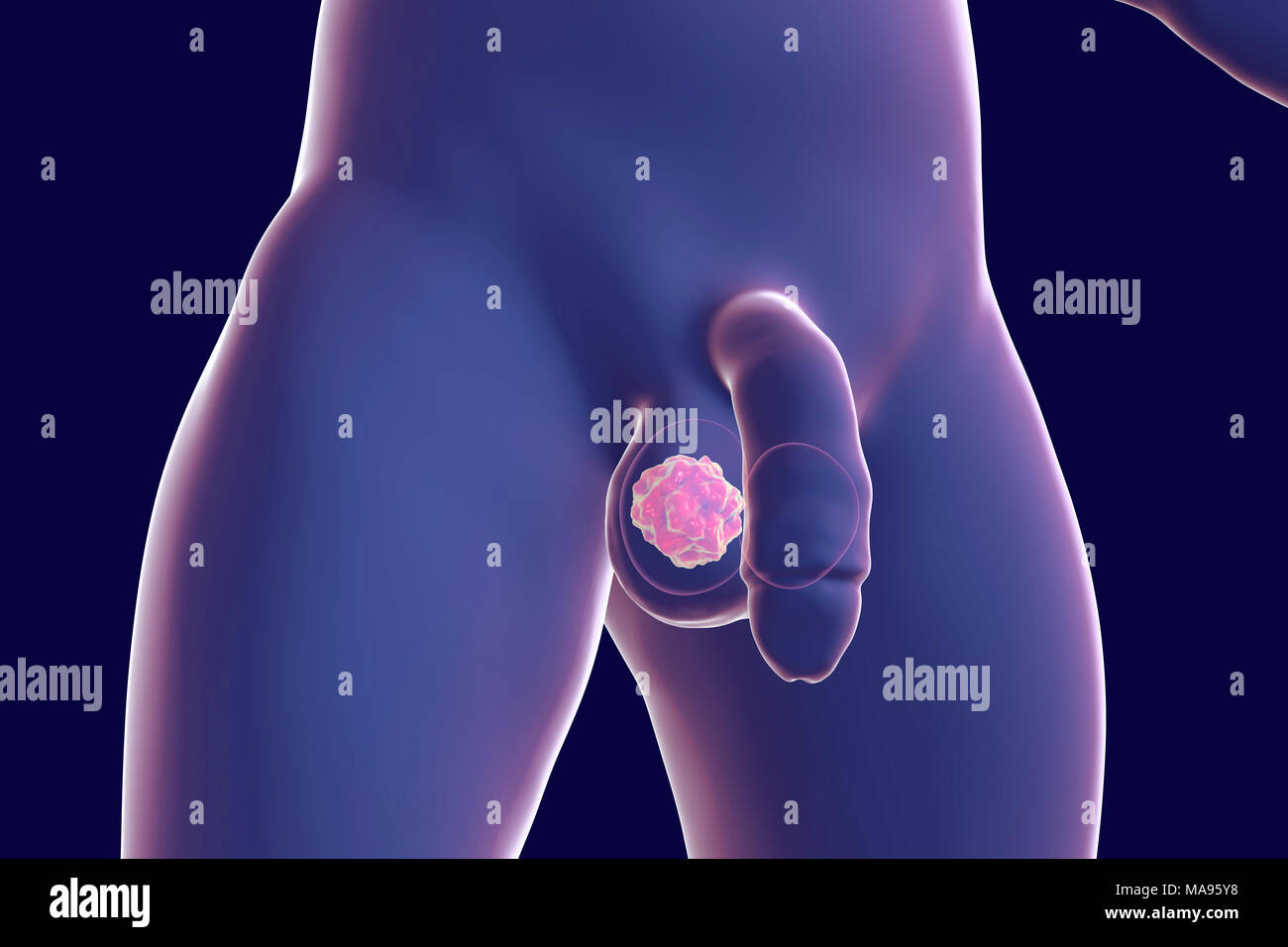 Testicular cancer, computer illustration. Stock Photo