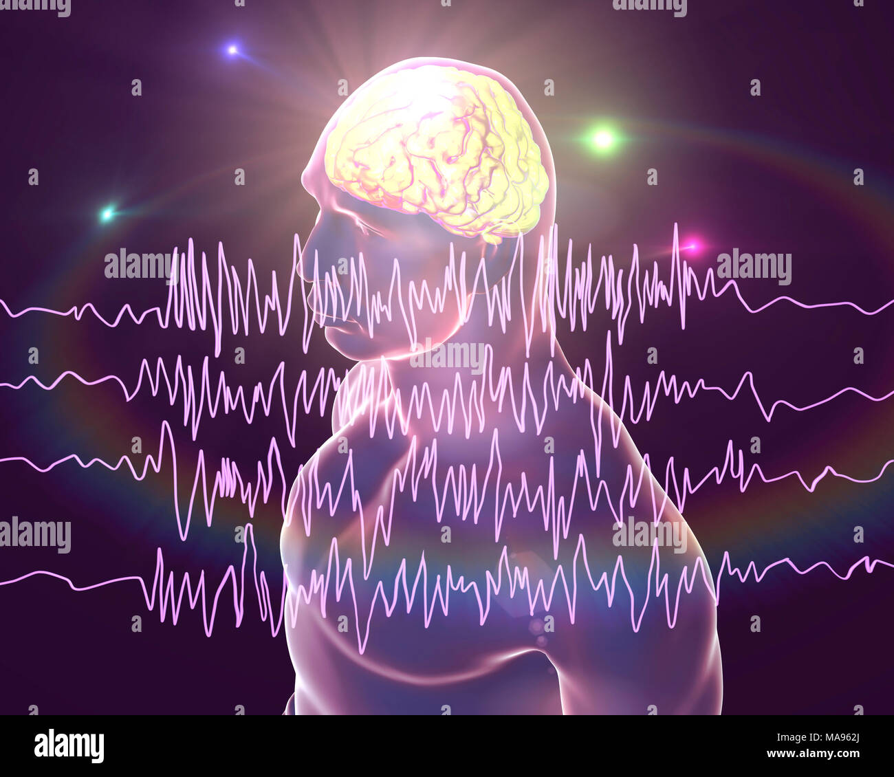 Brain and brain waves in epilepsy, computer illustration. This EEG