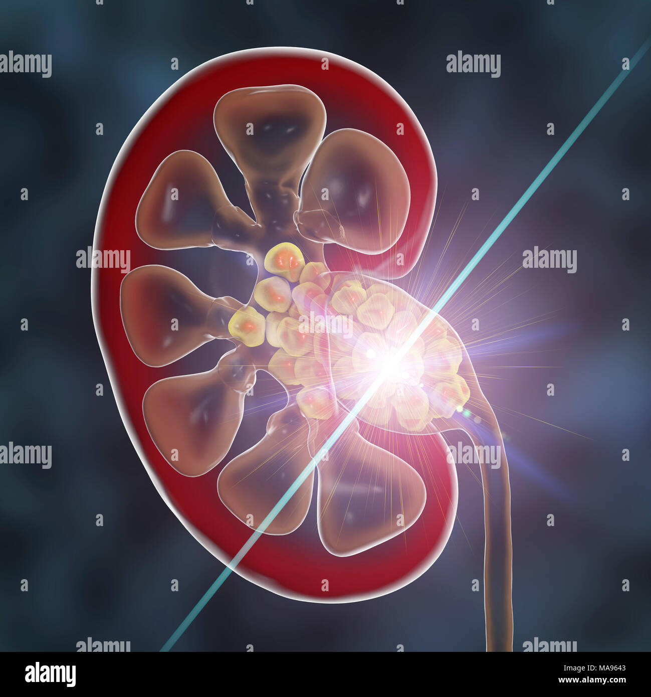Kidney stone ultrasound hires stock photography and images Alamy
