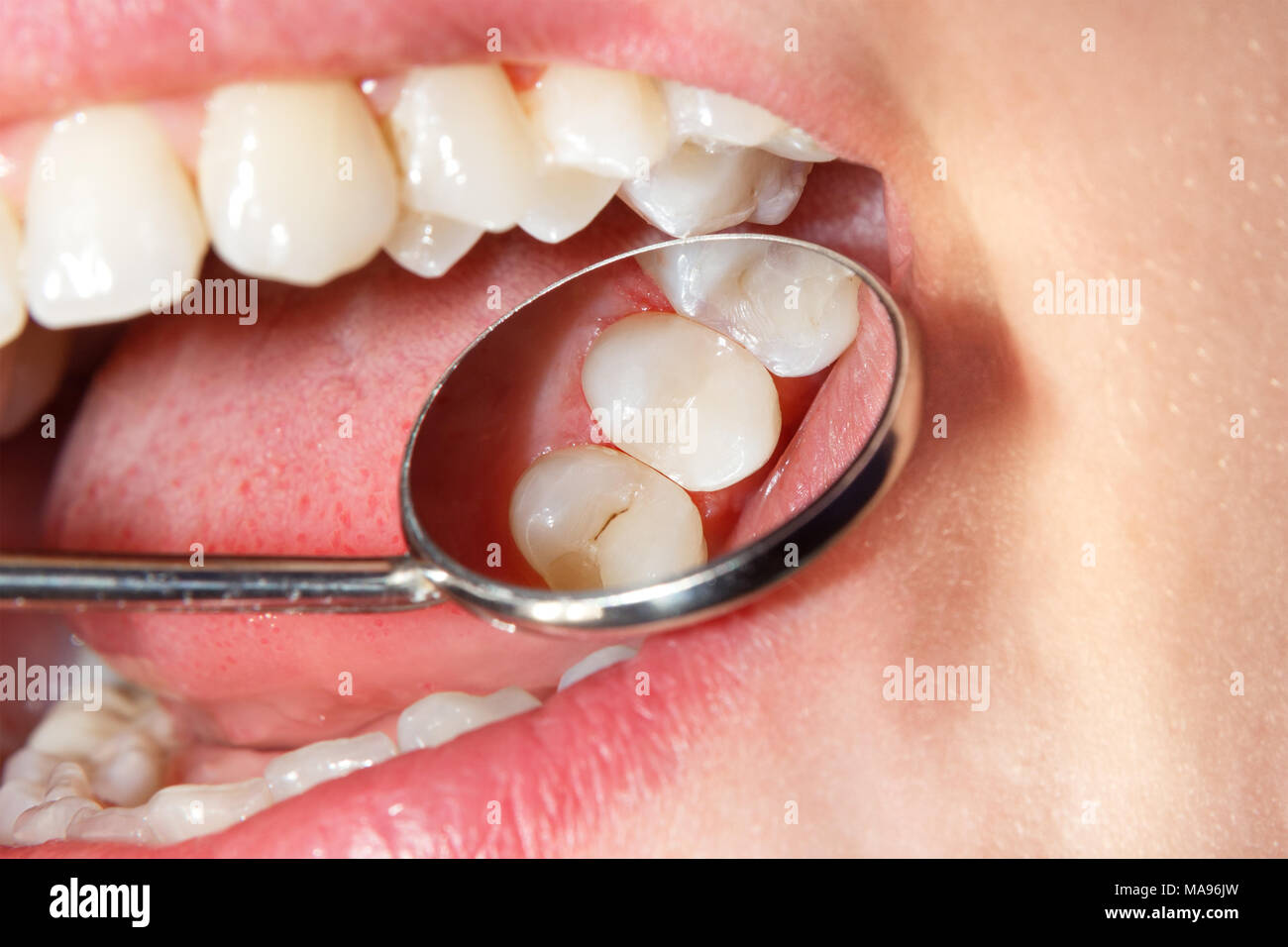 Dental treatment in the dental clinic. Rotten carious tooth close-up macro. Treatment of endodontic canals Stock Photo