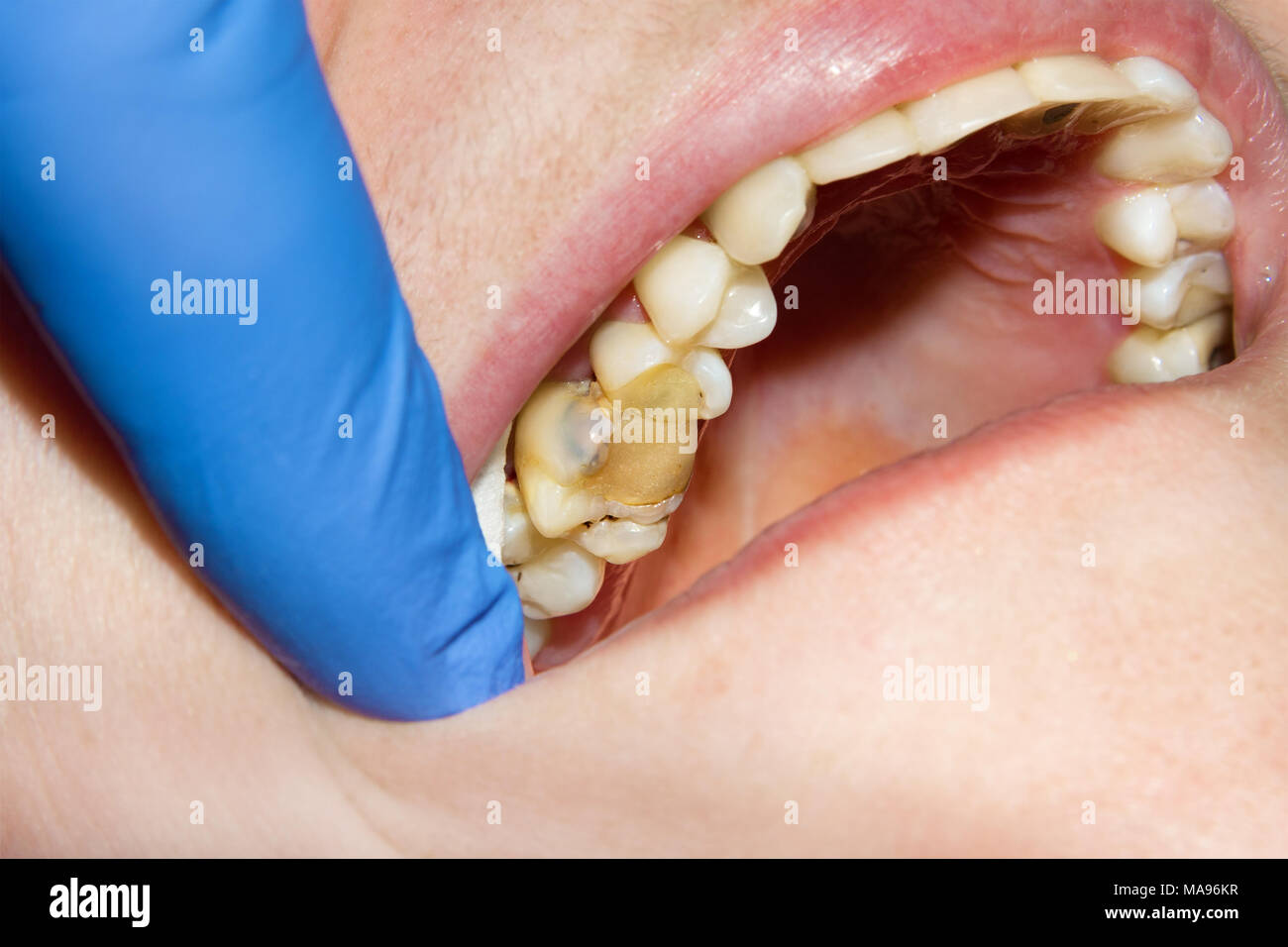 Dental treatment in the dental clinic. Rotten carious tooth close-up macro. Treatment of endodontic canals Stock Photo