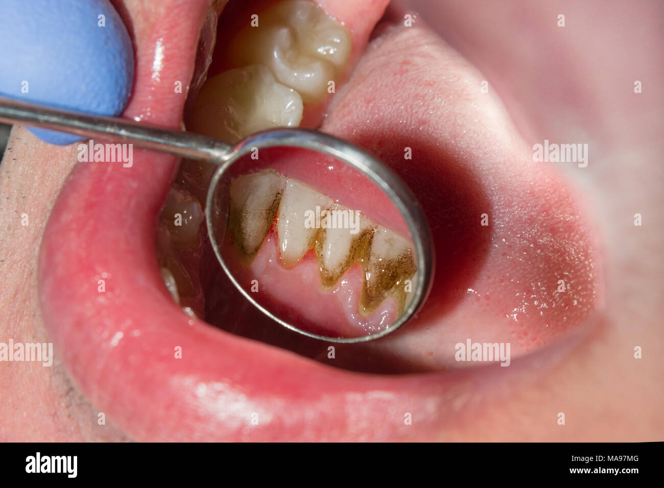 Dental calculus hi-res stock photography and images - Alamy