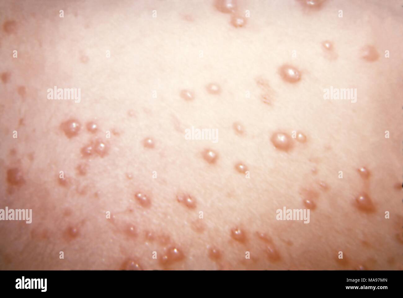 Herpesviridae chickenpox caused pustulovesicular rash on the skin due to the Varicella-zoster virus (VZV), 1975. Image courtesy Centers for Disease Control (CDC) / Joe Miller. () Stock Photo