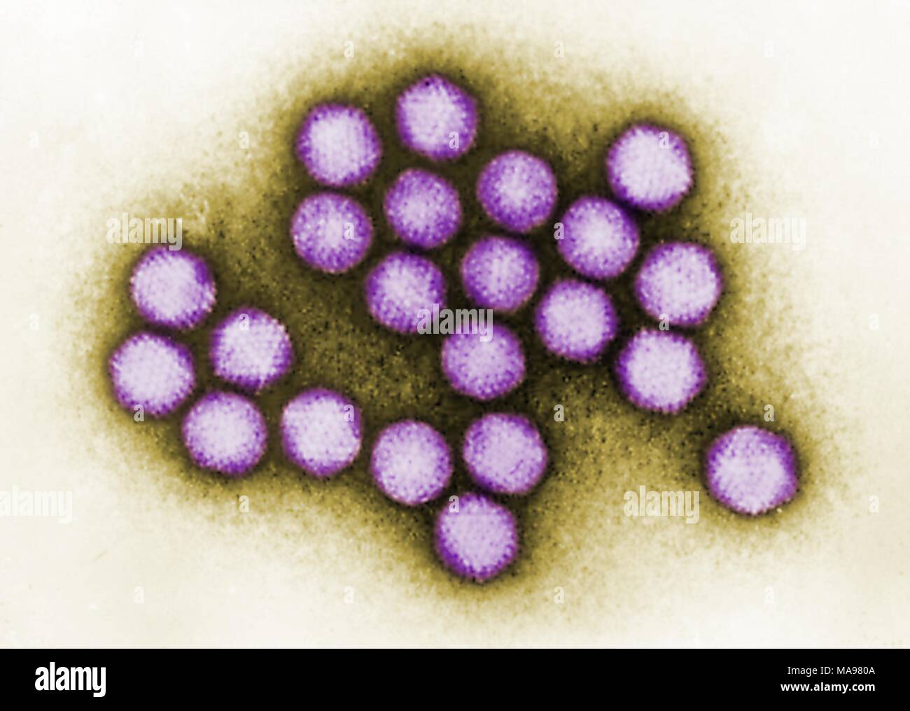 Colorized TEM (transmission electron microscopic) image of adenovirus, which can cause respiratory illnesses among other infections, 1981. Image courtesy CDC/Dr. G. William Gary, Jr. () Stock Photo