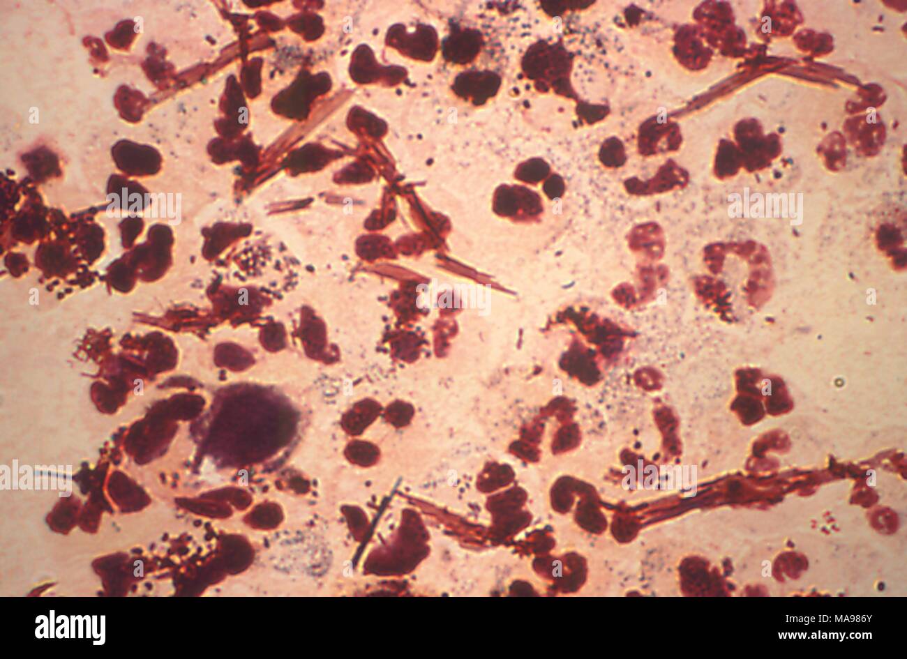 Neisseria gonorrhoeae bacteria revealed in the gram-stain image of a urethral discharge specimen, 1975. Image courtesy Centers for Disease Control (CDC) / Joe Miller. () Stock Photo