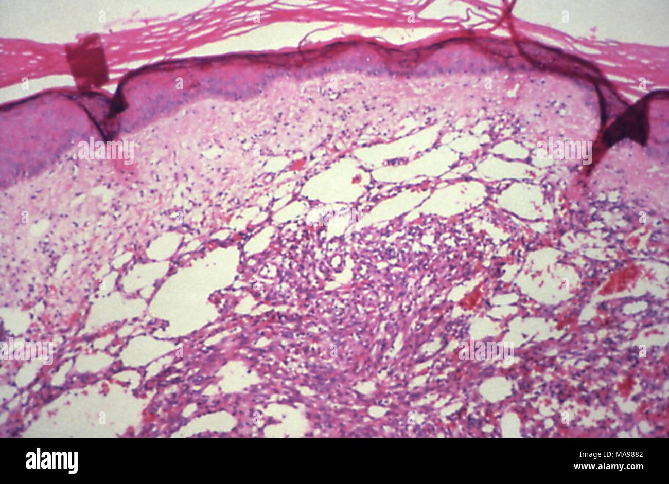 Kaposi's sarcoma revealed in the medium magnification photomicrograph of a cutaneous biopsy, 1981. Image courtesy Centers for Disease Control (CDC) / Dr Steve Kraus. () Stock Photo