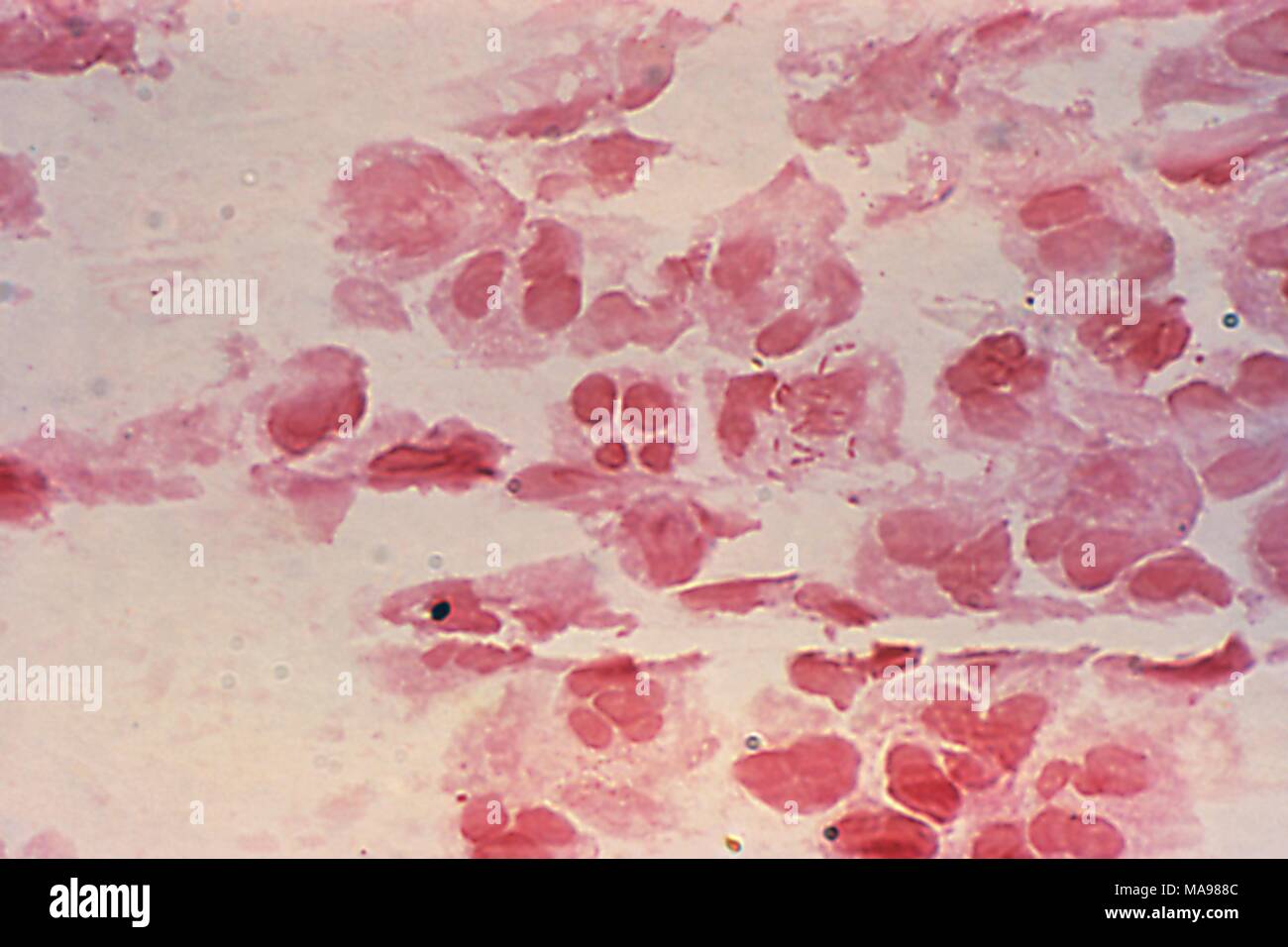 Neisseria gonorrhea Gram-negative intracellular rods revealed in the photomicrograph of the urethral discharge, 1975. Image courtesy Centers for Disease Control (CDC) / Joe Miller. () Stock Photo