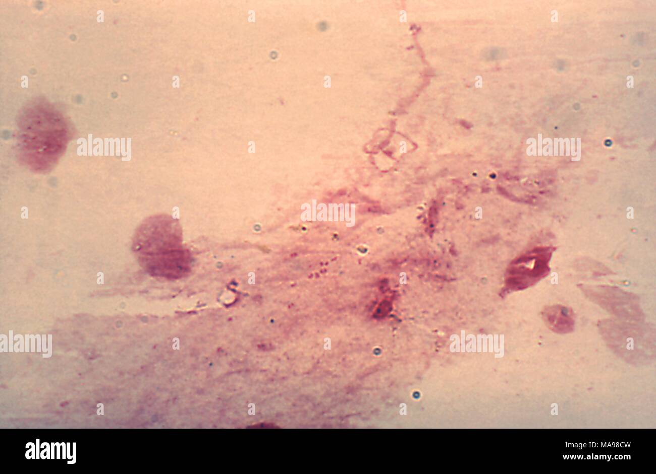 Neisseria gonorrhoeae bacteria revealed in the photomicrograph of the cervical smear, 1975. Image courtesy Centers for Disease Control (CDC) / Joe Miller. () Stock Photo