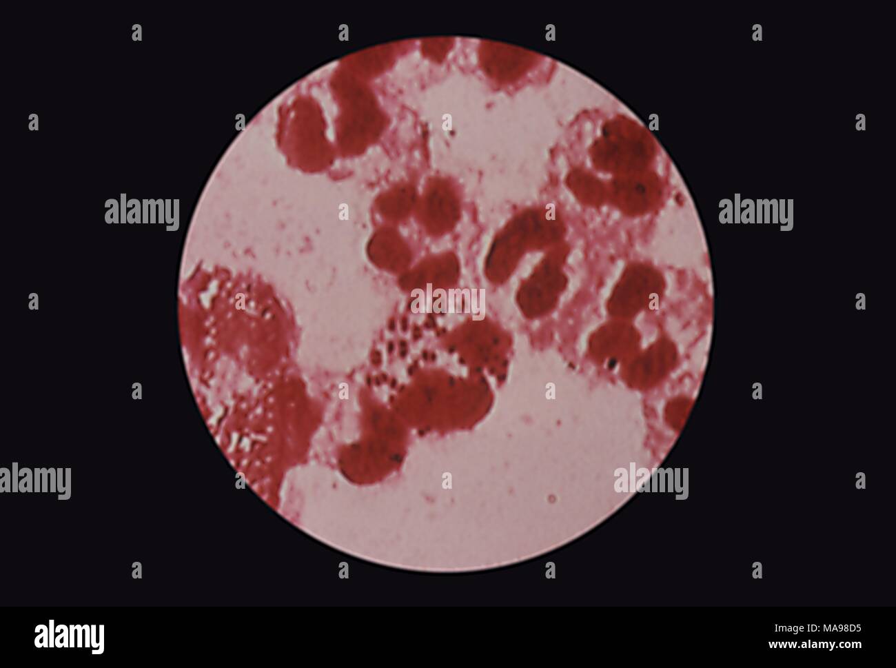 Neisseria gonorrhoeae, Gram-negative diplococcus bacterium, revealed in the photomicrograph of a urethral discharge specimen, 1978. Image courtesy Centers for Disease Control (CDC) / Susan Lindsley. () Stock Photo