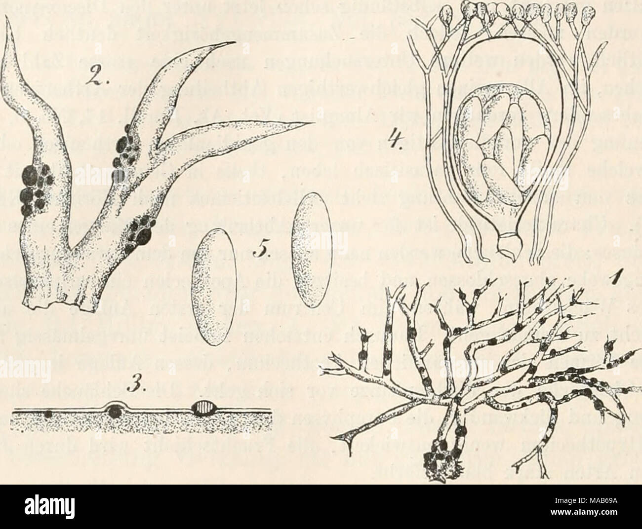 . Dr. L. Rabenhorst's Kryptogamen-Flora von Deutschland, Oesterreich und der Schweiz . Fig. 1—5. Phacopsis vulpina. Fig. 1. Ein Strauch von Evernia viüpina mit dem Pilz in natürlicher Grösse. Fig. 2. Ein Stück der Flechte mit Apothecien des Parasiten. Fig. 3. Querschnitt durch Apothecien. Fig. 4. Schlauch mit Paraphysen. Fig. 5. Sporen. (Fig. 2 massig, Fig. 4—5 stark vergrüssert. Sämmtliche Original- zeichnungen nach der Natur.) Conida. Apothecien meist gehäuft, anfangs unterrindig, dann hervorhrechend und sitzend, mit runder, flacher oder gewölbter, imberandeter Fruchtscheibe, schwarz. Schläu Stock Photo