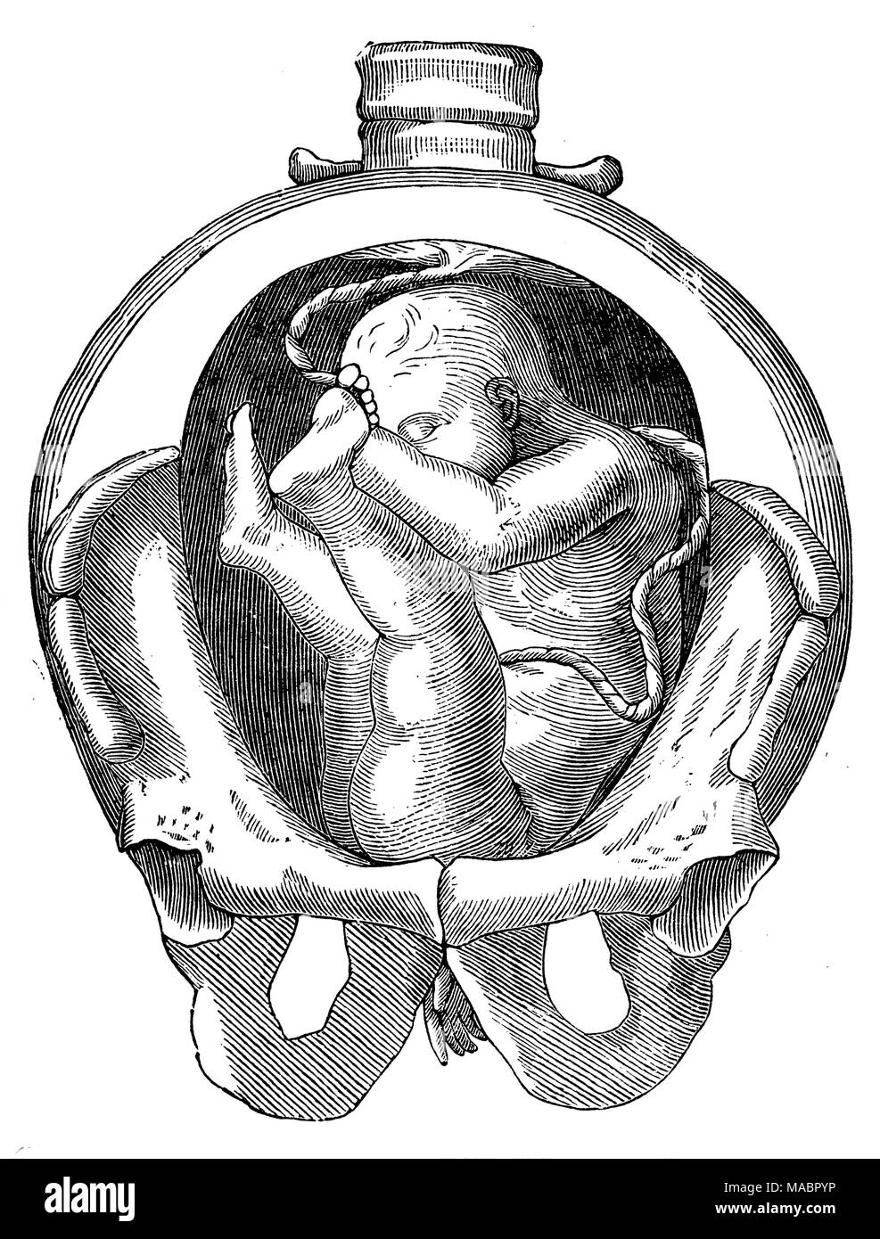 Position of a child in the uterus: Breech position with prolapse of the right arm Stock Photo