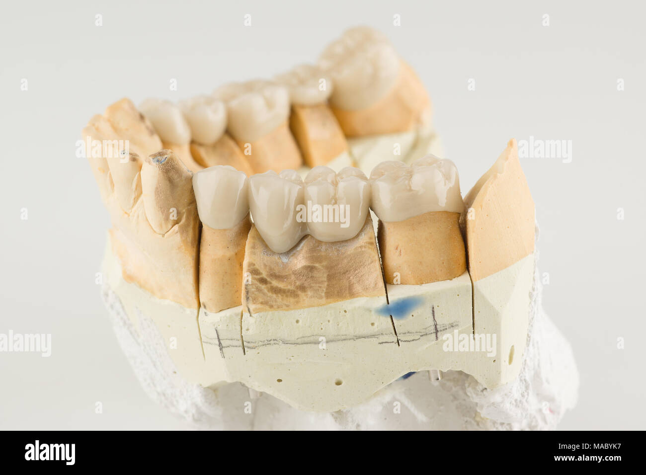 artificial dental structures made of ceramics for restoration of