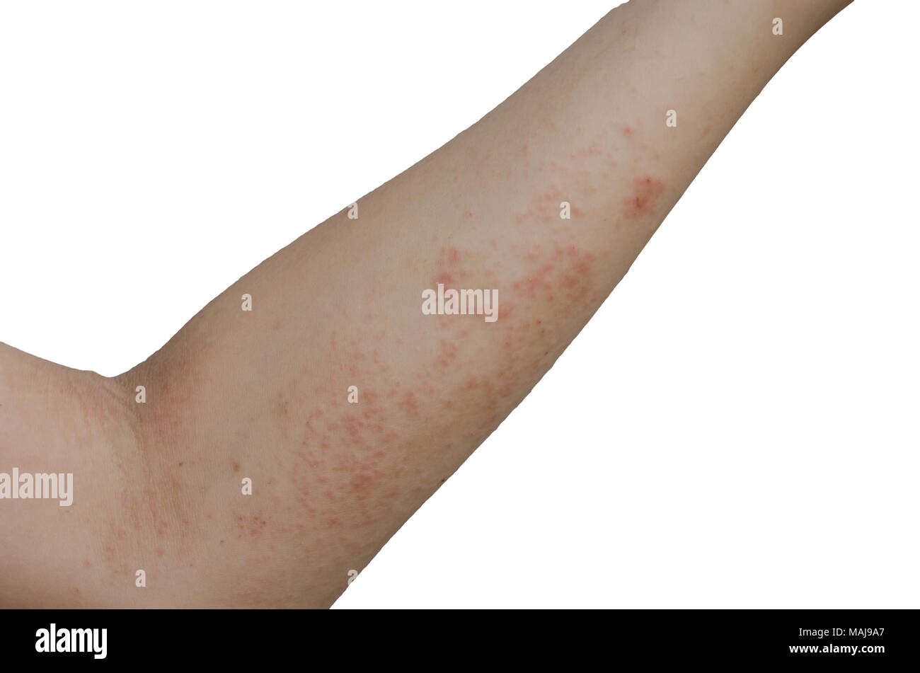 Skin Rash On Arms