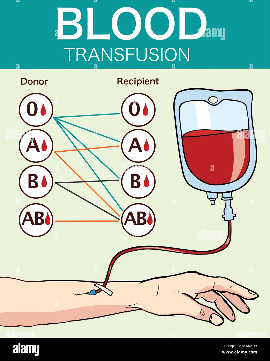 VECTOR ILLUSTRATION OF A BLOOD  TRANSFUSION Stock Vector