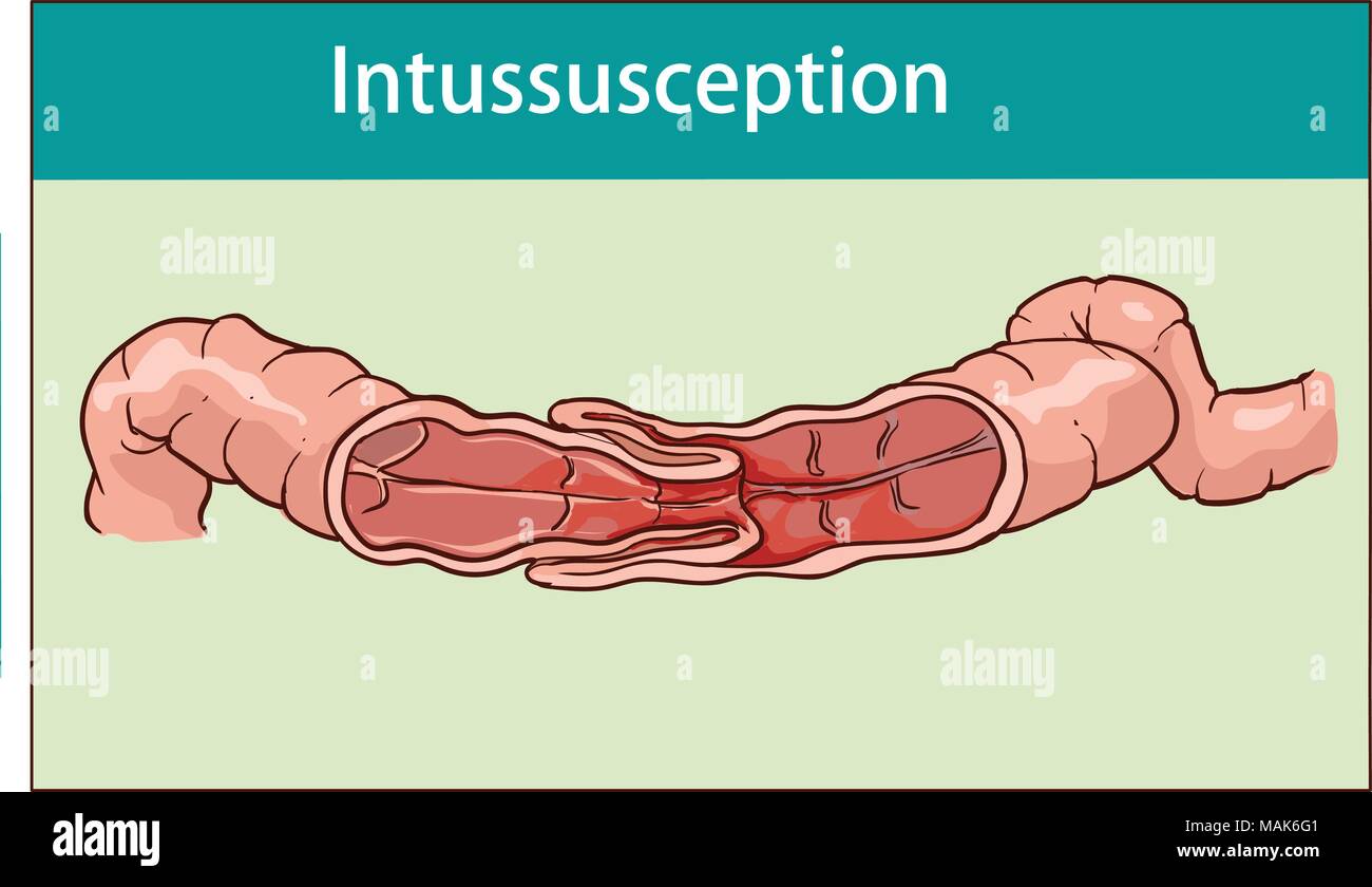 vector illustration of intussusception of intestine. obstruction. Stock Vector