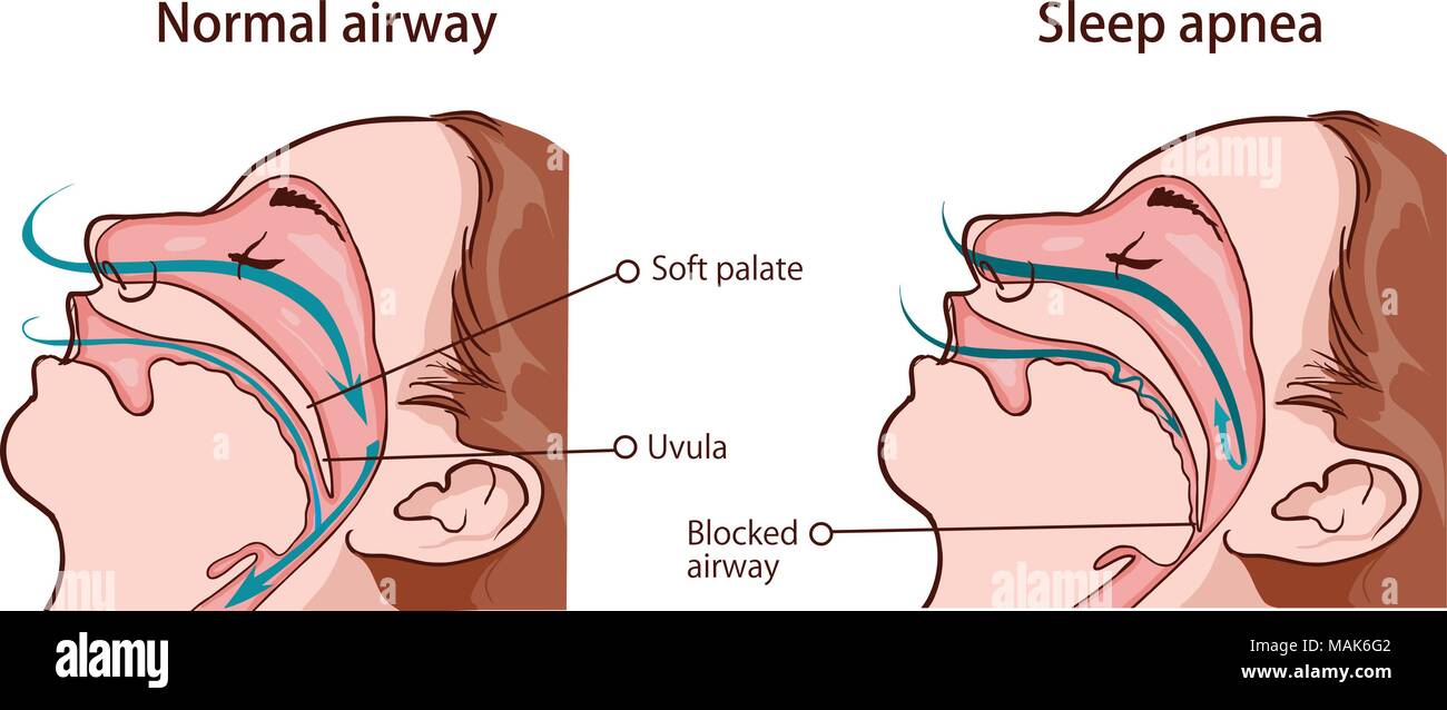 SLEEP APNEA SYNDROME Stock Vector Image & Art - Alamy